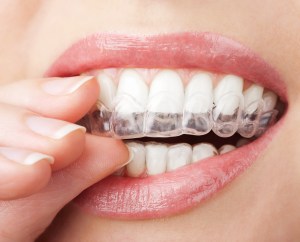 Night Guard for Teeth Grinding Treatment